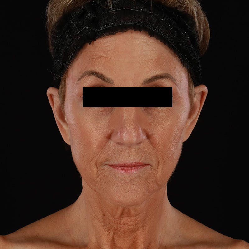 Facelift Before & After Gallery - Patient 222689 - Image 1