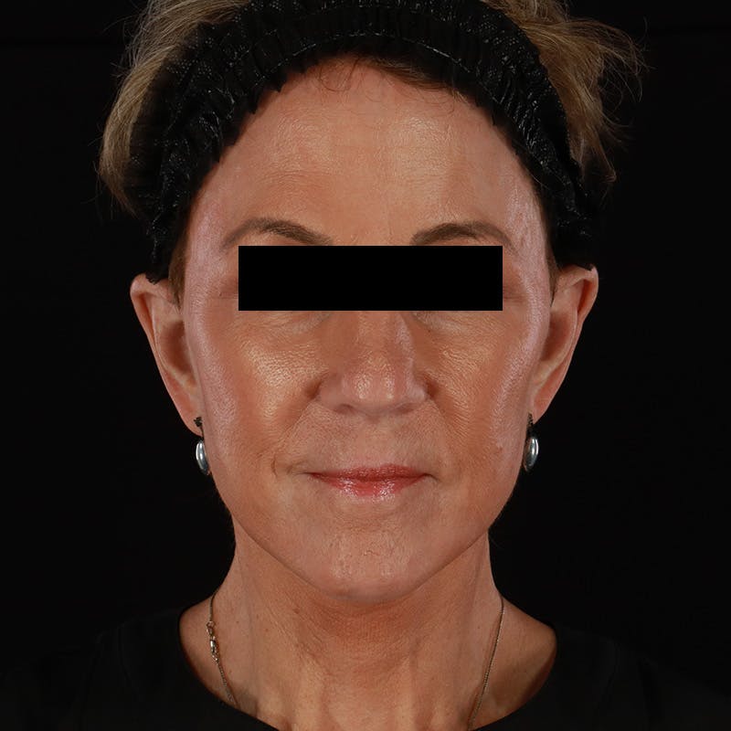 Facelift Before & After Gallery - Patient 222689 - Image 2