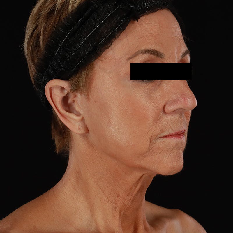 Facelift Before & After Gallery - Patient 222689 - Image 3