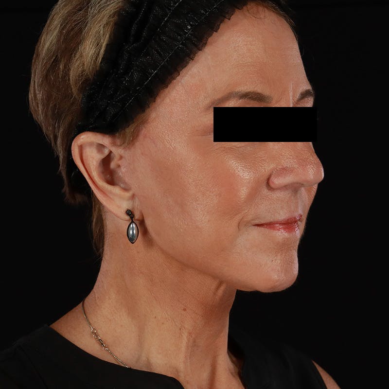 Facelift Before & After Gallery - Patient 222689 - Image 4