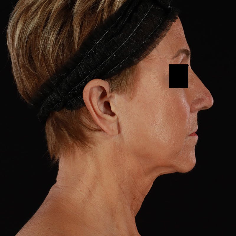 Facelift Before & After Gallery - Patient 222689 - Image 5