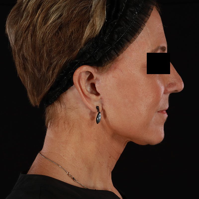 Facelift Before & After Gallery - Patient 222689 - Image 6