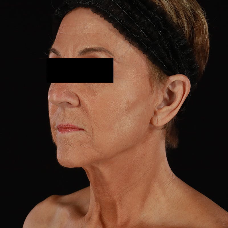 Facelift Before & After Gallery - Patient 222689 - Image 7