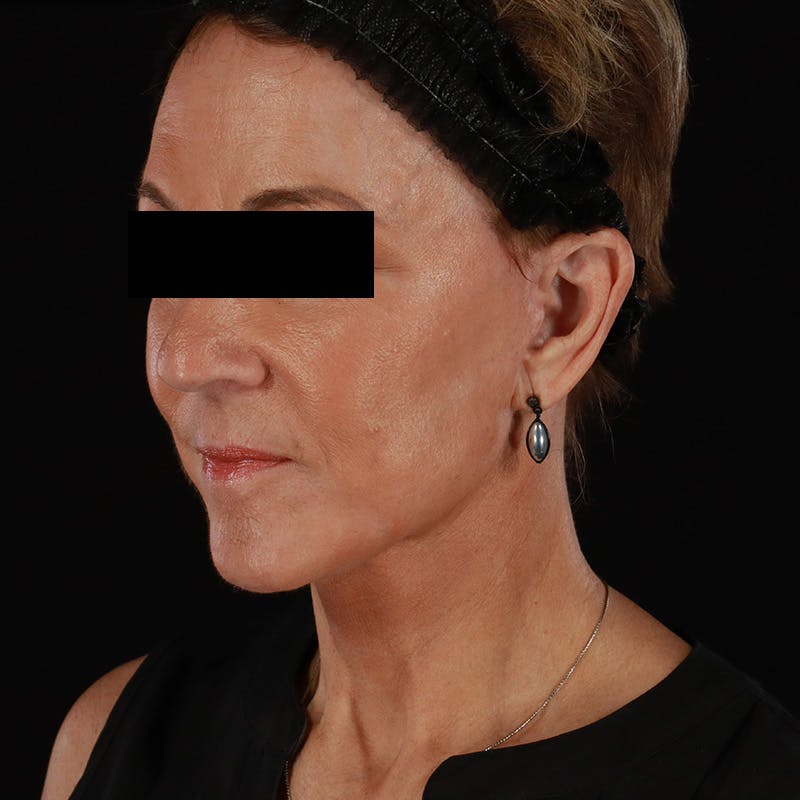 Facelift Before & After Gallery - Patient 222689 - Image 8