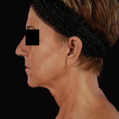 Neck Lift Before & After Gallery - Patient 818107 - Image 1