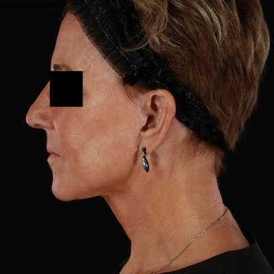 Neck Lift Before & After Gallery - Patient 818107 - Image 2