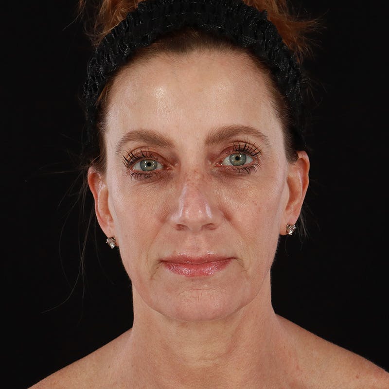 Morpheus8 Before & After Gallery - Patient 248230 - Image 1