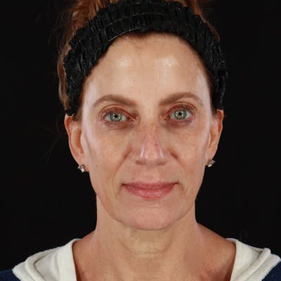 Sculptra Before & After Gallery - Patient 244460 - Image 2
