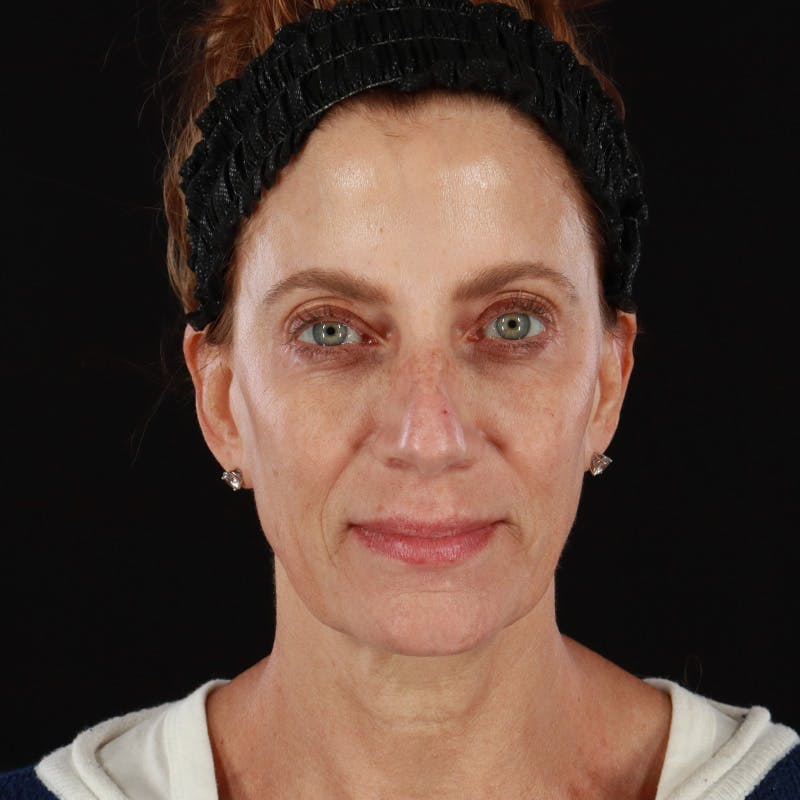 Morpheus8 Before & After Gallery - Patient 248230 - Image 2