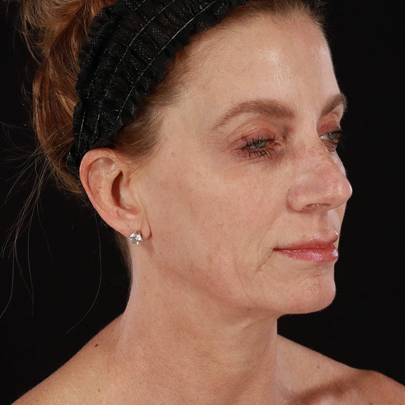 Morpheus8 Before & After Gallery - Patient 248230 - Image 3