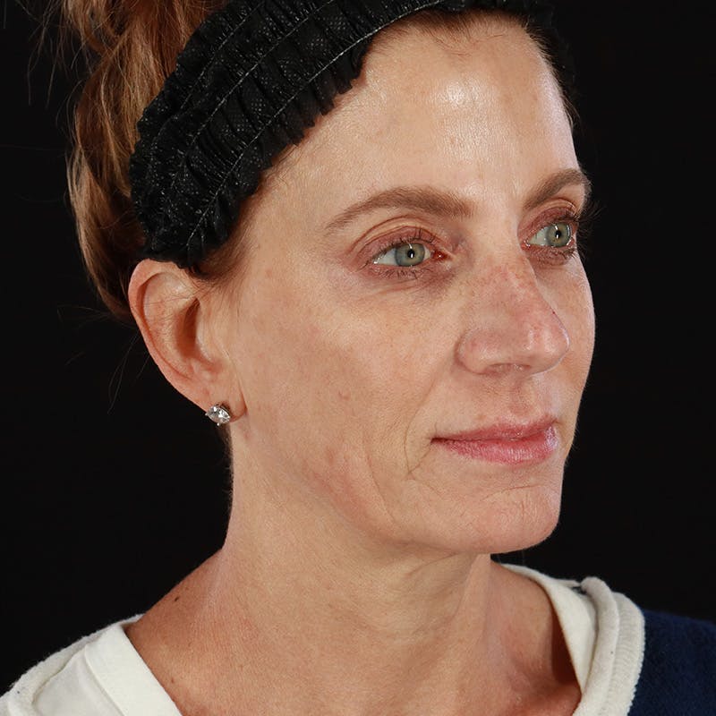 Morpheus8 Before & After Gallery - Patient 248230 - Image 4