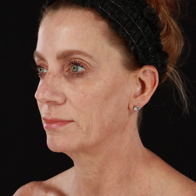 Morpheus8 Before & After Gallery - Patient 248230 - Image 7