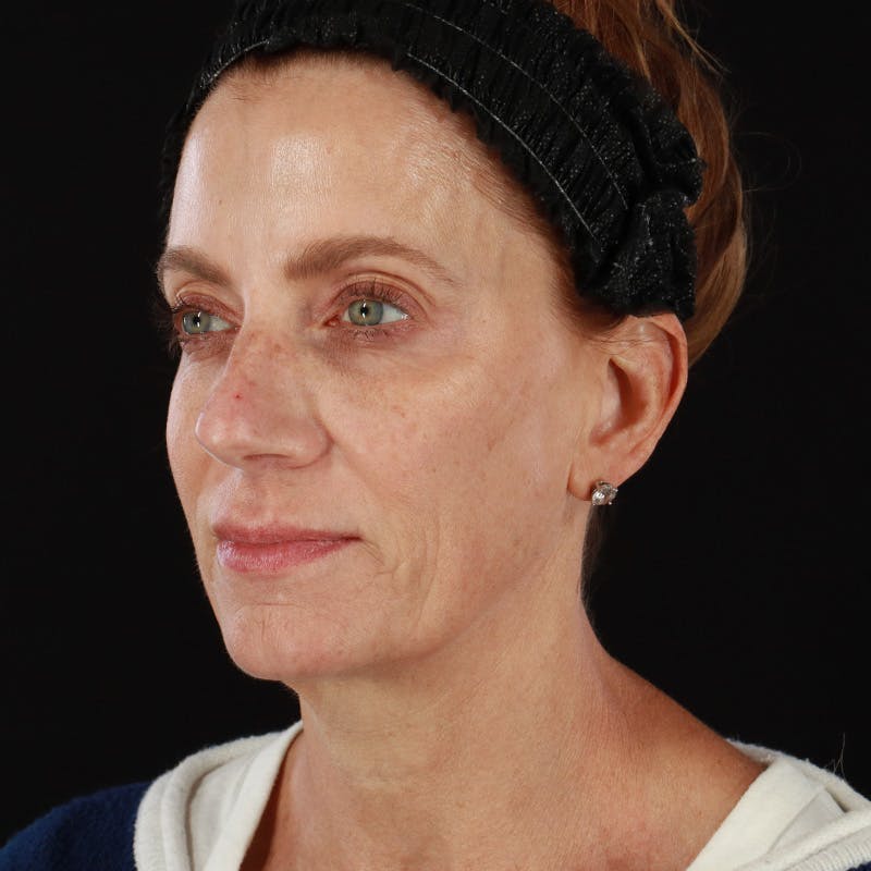 Morpheus8 Before & After Gallery - Patient 248230 - Image 8