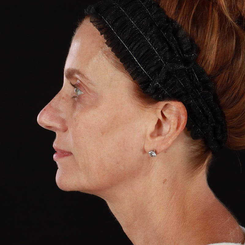 Morpheus8 Before & After Gallery - Patient 248230 - Image 10