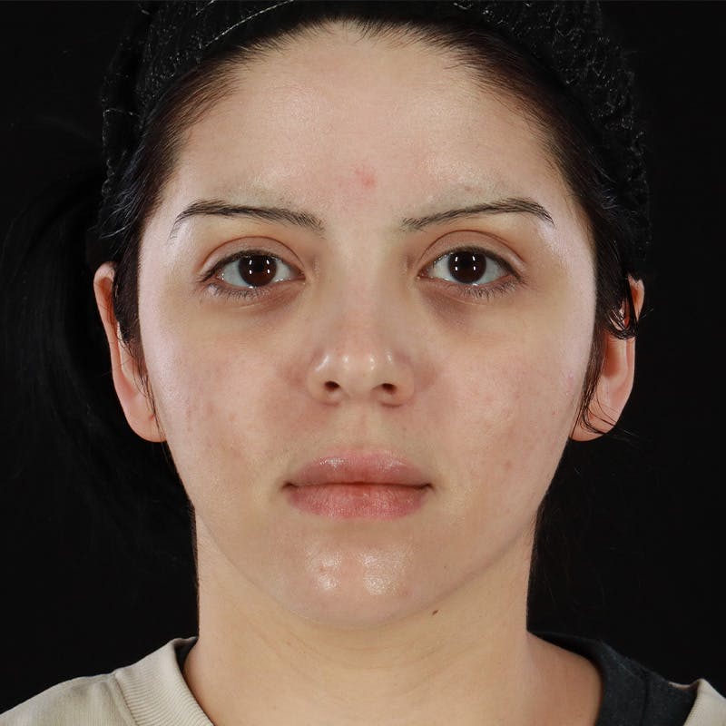 Dermal Fillers Before & After Gallery - Patient 204281 - Image 1
