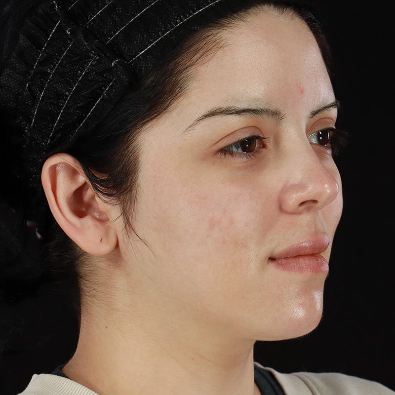 Dermal Fillers Before & After Gallery - Patient 204281 - Image 3
