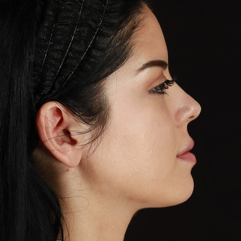Dermal Fillers Before & After Gallery - Patient 204281 - Image 6