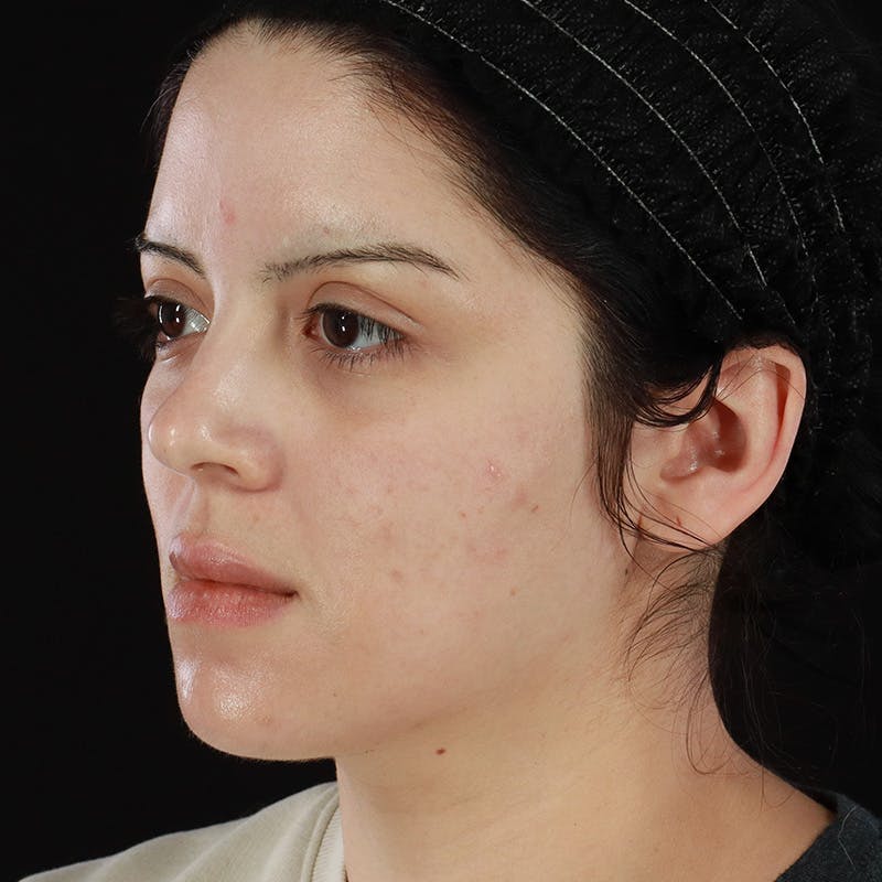 Dermal Fillers Before & After Gallery - Patient 204281 - Image 7