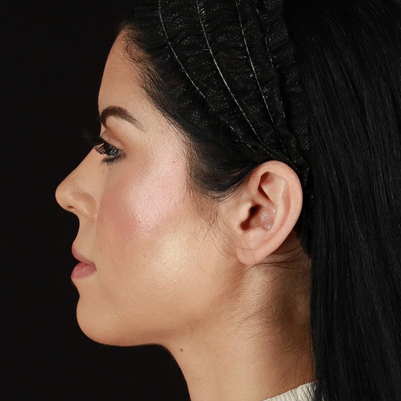 Dermal Fillers Before & After Gallery - Patient 204281 - Image 9