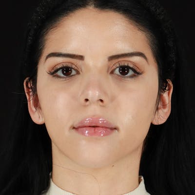 BroadBand Light™ Therapy Before & After Gallery - Patient 728469 - Image 2