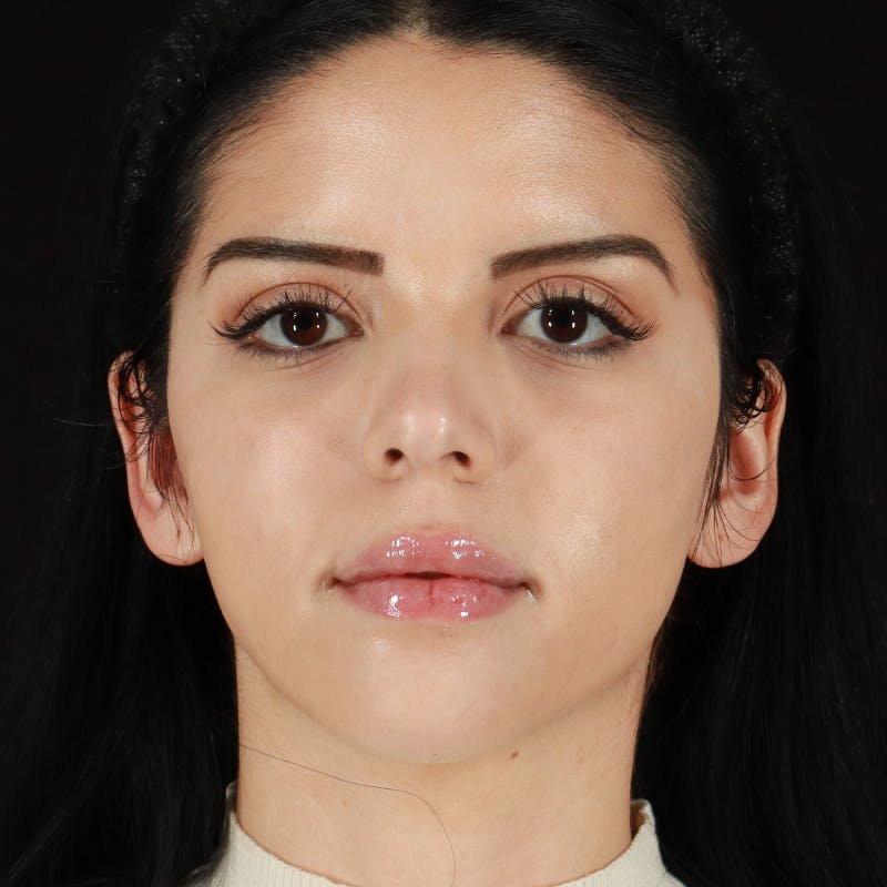Dermal Fillers Before & After Gallery - Patient 204281 - Image 2