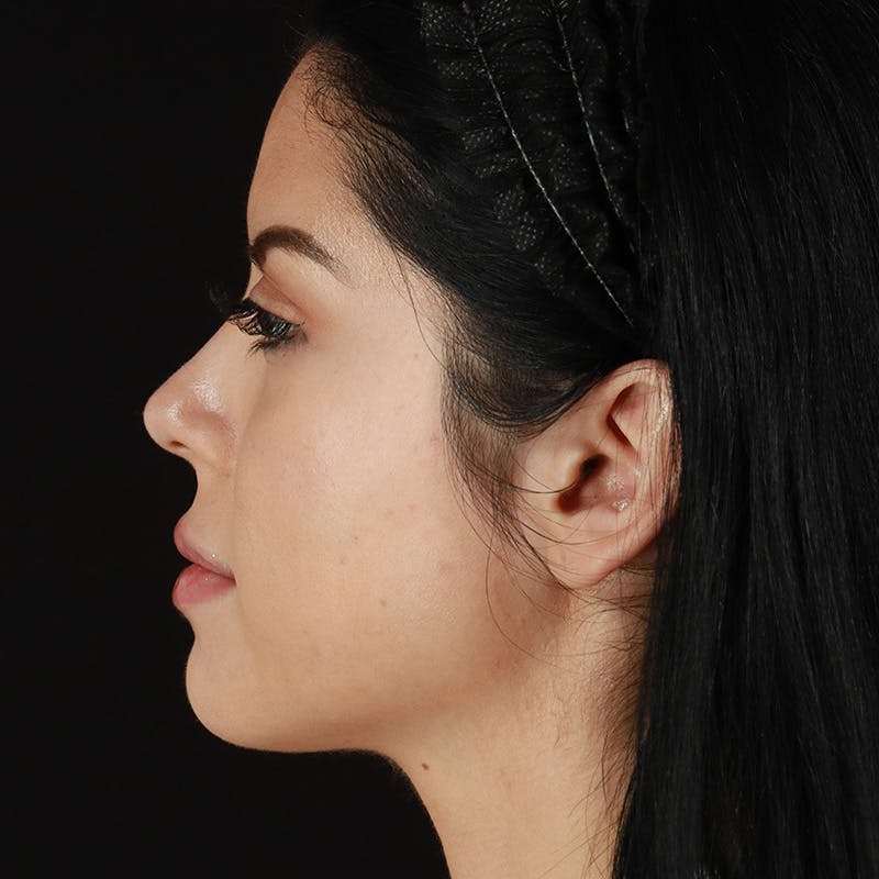 Dermal Fillers Before & After Gallery - Patient 204281 - Image 10