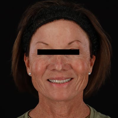 Sculptra Before & After Gallery - Patient 309702 - Image 1