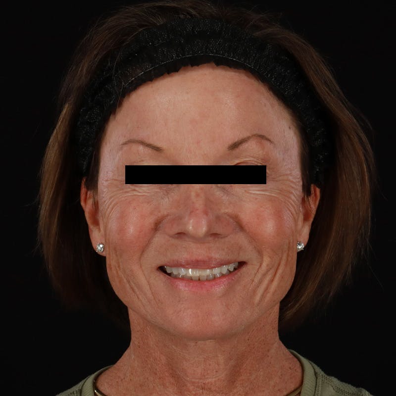 Sculptra Before & After Gallery - Patient 309702 - Image 1