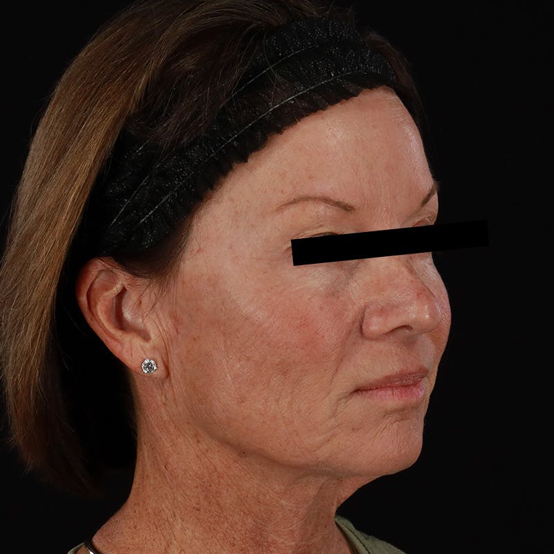 Sculptra Before & After Gallery - Patient 309702 - Image 3