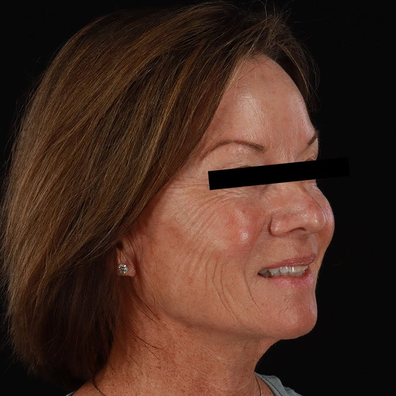 Sculptra Before & After Gallery - Patient 309702 - Image 4