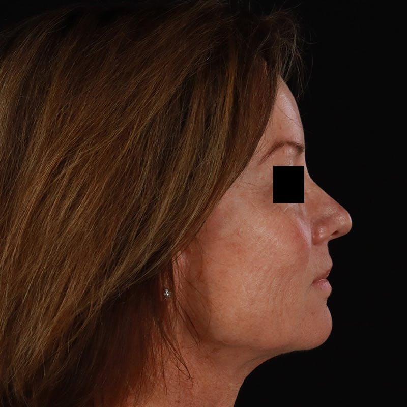 Sculptra Before & After Gallery - Patient 309702 - Image 6