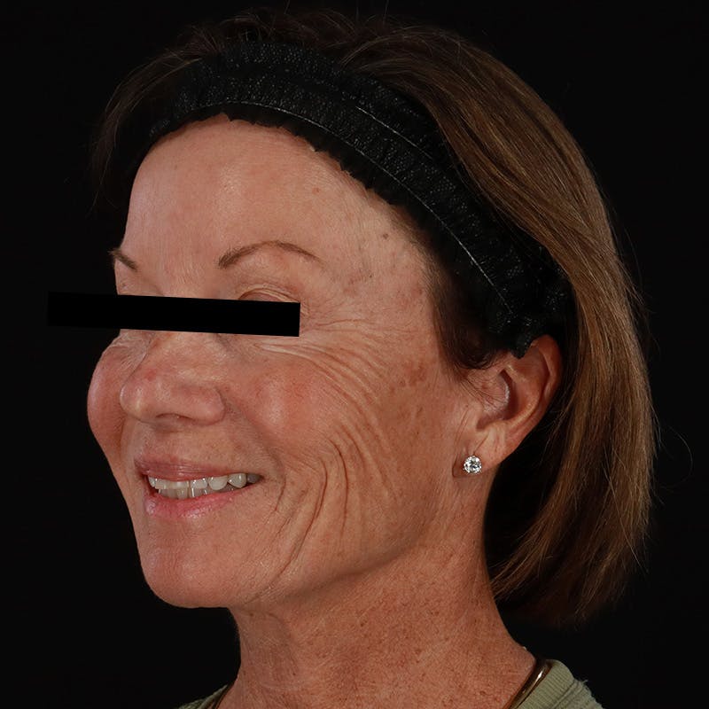 Sculptra Before & After Gallery - Patient 309702 - Image 7