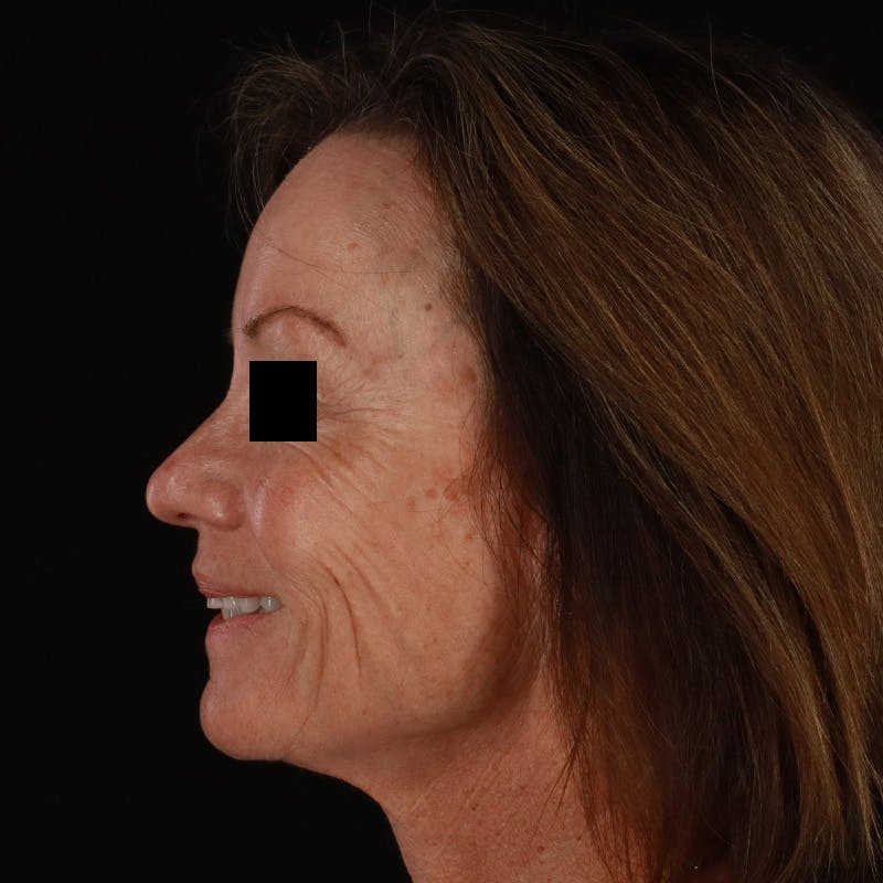 Sculptra Before & After Gallery - Patient 309702 - Image 10