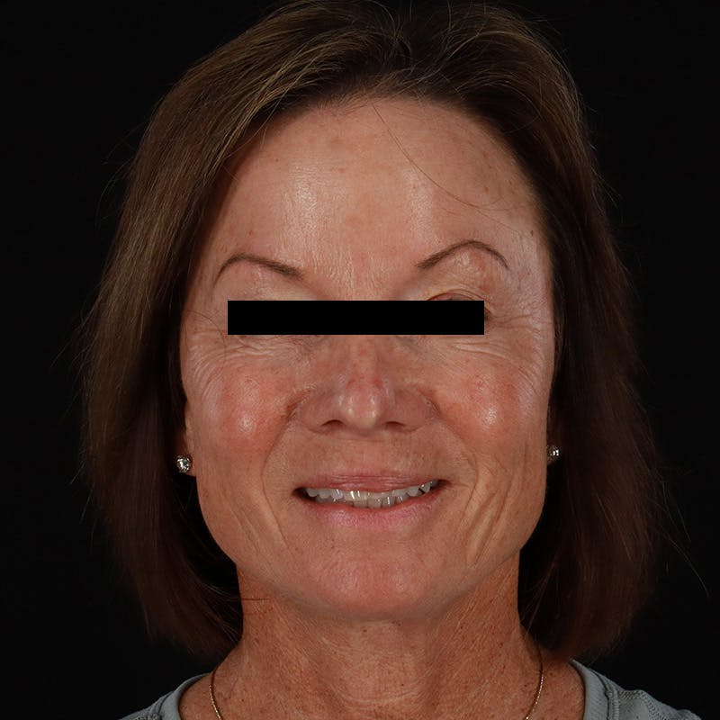 Sculptra Before & After Gallery - Patient 309702 - Image 2