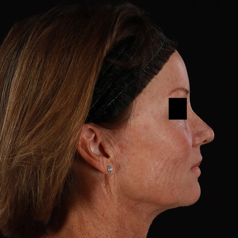 Sculptra Before & After Gallery - Patient 309702 - Image 5