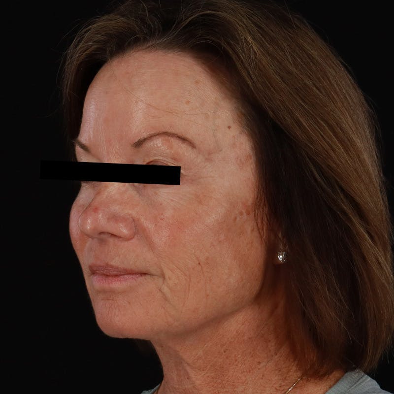 Sculptra Before & After Gallery - Patient 309702 - Image 8