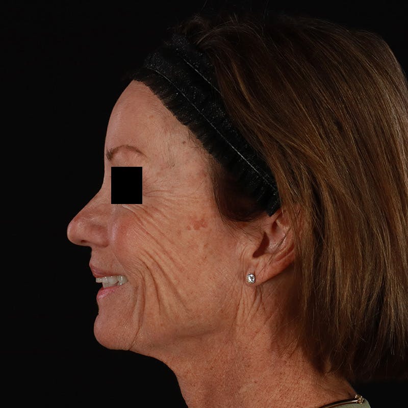 Sculptra Before & After Gallery - Patient 309702 - Image 9