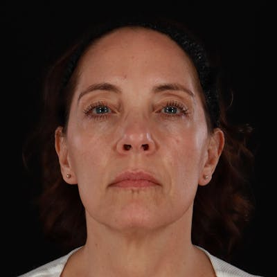 Sculptra Before & After Gallery - Patient 203416 - Image 1
