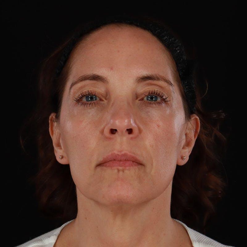 Sculptra Before & After Gallery - Patient 203416 - Image 1