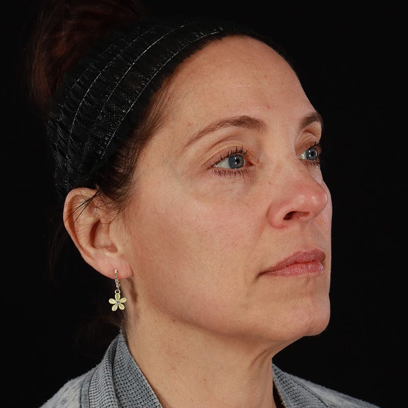 Sculptra Before & After Gallery - Patient 203416 - Image 4