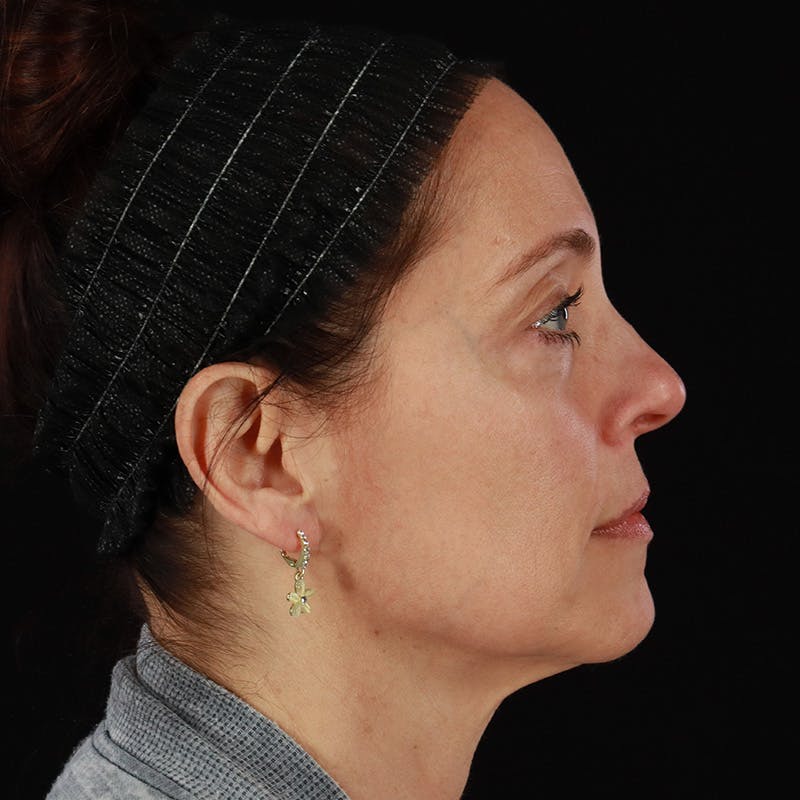Sculptra Before & After Gallery - Patient 203416 - Image 6