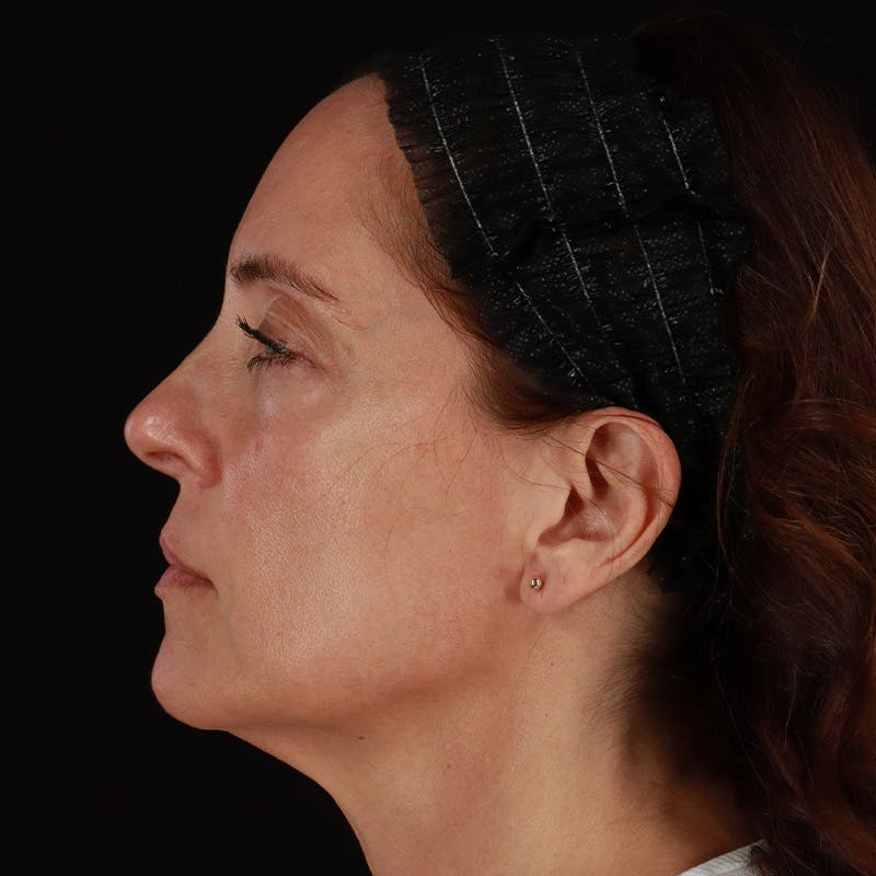 Sculptra Before & After Gallery - Patient 203416 - Image 9