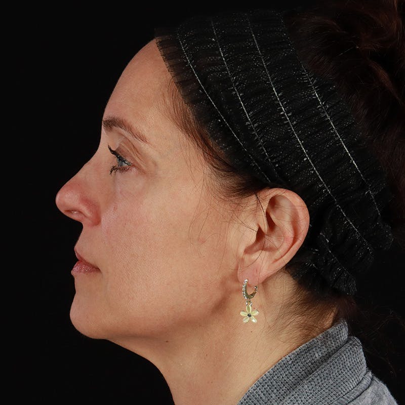 Sculptra Before & After Gallery - Patient 203416 - Image 10