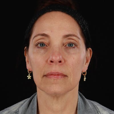 Sculptra Before & After Gallery - Patient 203416 - Image 2
