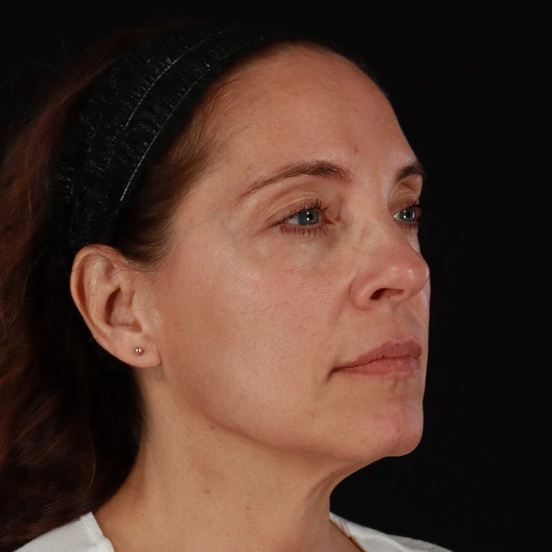 Sculptra Before & After Gallery - Patient 203416 - Image 3