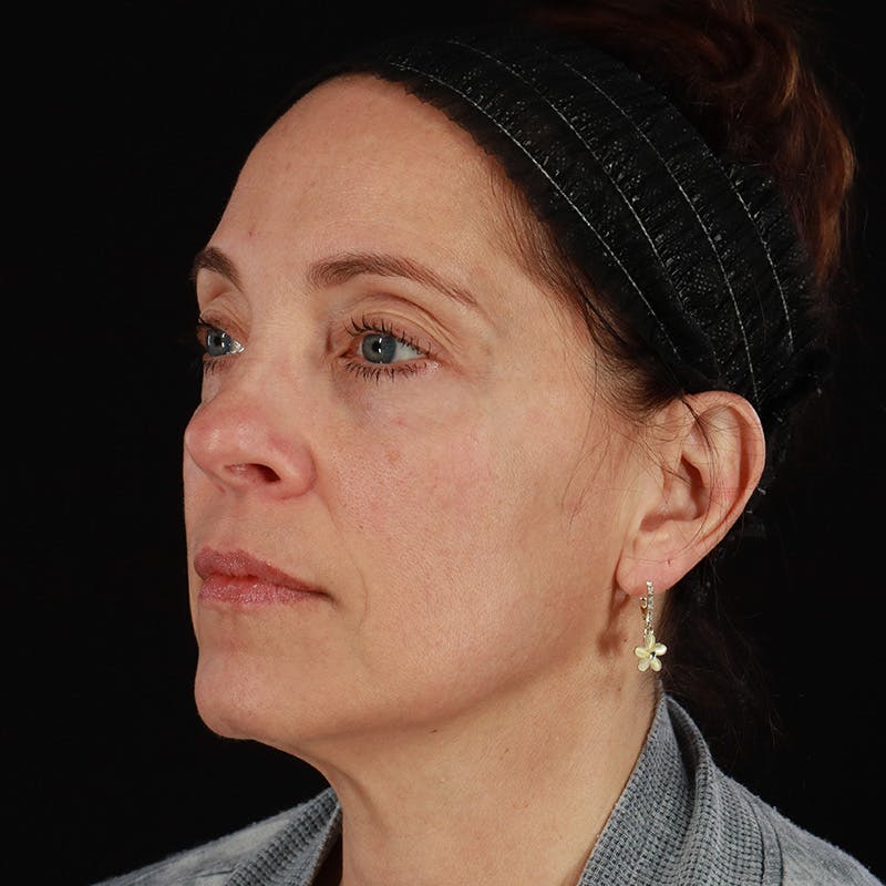 Sculptra Before & After Gallery - Patient 203416 - Image 8