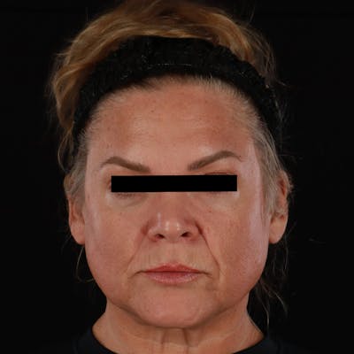 Sculptra Before & After Gallery - Patient 263404 - Image 1