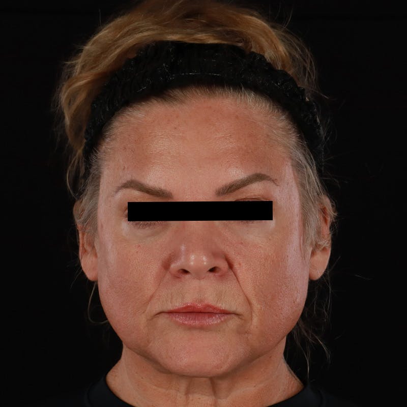 Morpheus8 Before & After Gallery - Patient 110627 - Image 1