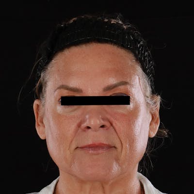 Sculptra Before & After Gallery - Patient 263404 - Image 2