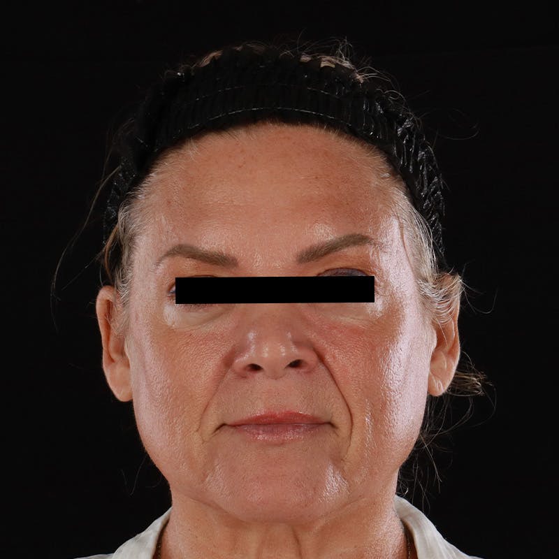 Morpheus8 Before & After Gallery - Patient 110627 - Image 2
